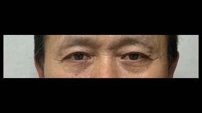 Sub-brow Lift, Ptosis Correction — RE&RE PLASTIC SURGERY 2