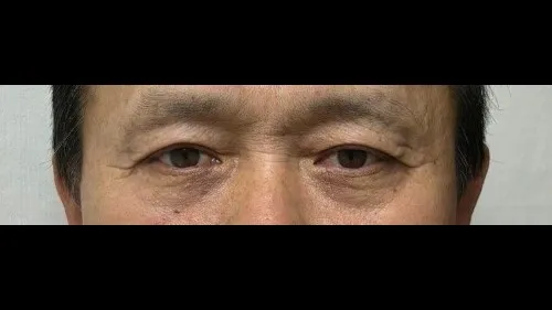 Sub-brow Lift, Ptosis Correction — RE&RE PLASTIC SURGERY 3