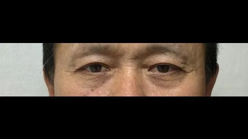 Sub-brow Lift, Ptosis Correction — RE&RE PLASTIC SURGERY 4