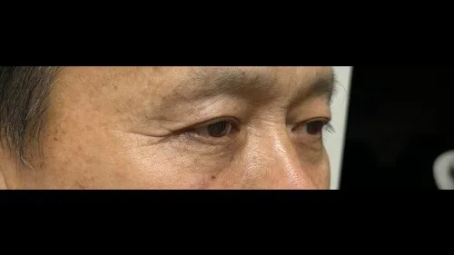 Sub-brow Lift, Ptosis Correction — RE&RE PLASTIC SURGERY 5