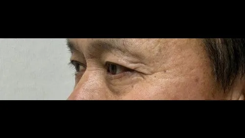 Sub-brow Lift, Ptosis Correction — RE&RE PLASTIC SURGERY 6