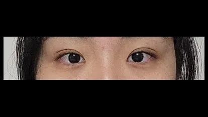 Natural Adhesion Double Eyelid Surgery, Ptosis Correction — RE&RE PLASTIC SURGERY 2