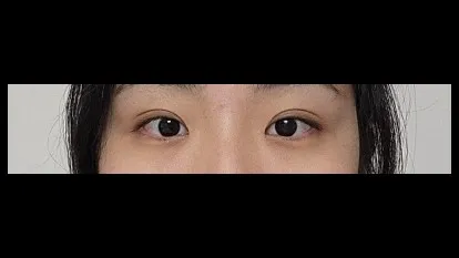 Natural Adhesion Double Eyelid Surgery, Ptosis Correction — RE&RE PLASTIC SURGERY 3