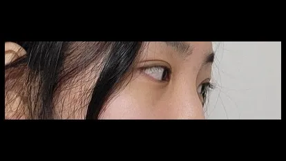 Natural Adhesion Double Eyelid Surgery, Ptosis Correction — RE&RE PLASTIC SURGERY 4