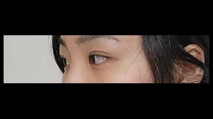 Natural Adhesion Double Eyelid Surgery, Ptosis Correction — RE&RE PLASTIC SURGERY 5