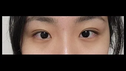 Natural Adhesion Double Eyelid Surgery, Ptosis Correction — RE&RE PLASTIC SURGERY 6