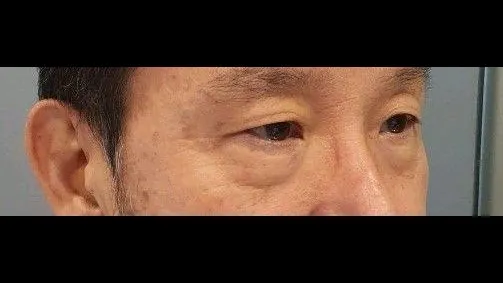 Sub-brow Lift, Lower Blepharoplasty (Aging Eye Rejuvenation), Lower Eyelid Fat Repositioning — RE&RE PLASTIC SURGERY 2