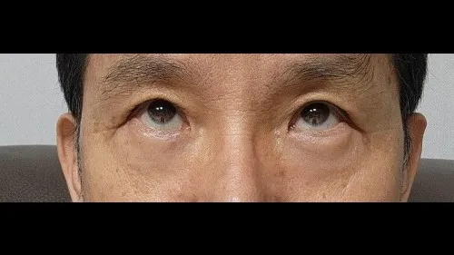 Sub-brow Lift, Lower Blepharoplasty (Aging Eye Rejuvenation), Lower Eyelid Fat Repositioning — RE&RE PLASTIC SURGERY 5