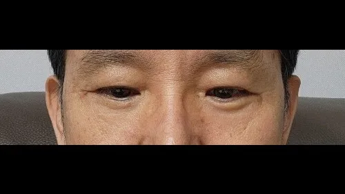 Sub-brow Lift, Lower Blepharoplasty (Aging Eye Rejuvenation), Lower Eyelid Fat Repositioning — RE&RE PLASTIC SURGERY 6