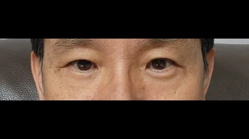 Sub-brow Lift, Lower Blepharoplasty (Aging Eye Rejuvenation), Lower Eyelid Fat Repositioning — RE&RE PLASTIC SURGERY 3