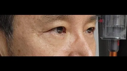 Sub-brow Lift, Lower Blepharoplasty (Aging Eye Rejuvenation), Lower Eyelid Fat Repositioning — RE&RE PLASTIC SURGERY 4