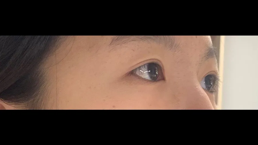 Incisional Double Eyelid Surgery, Ptosis Correction — RE&RE PLASTIC SURGERY 3