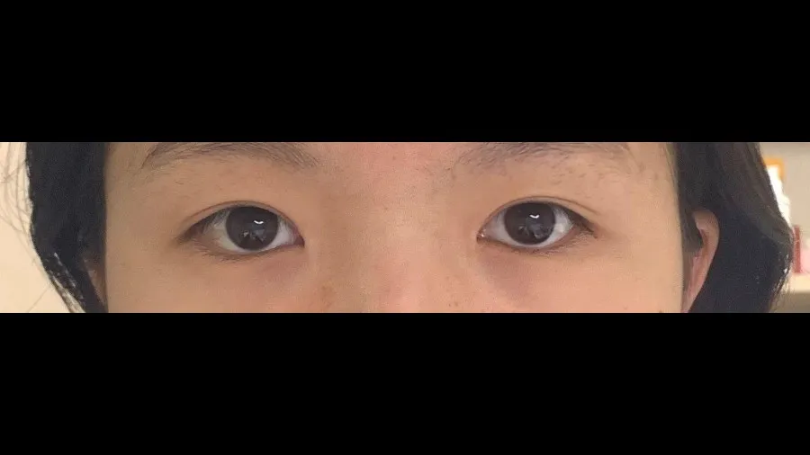 Incisional Double Eyelid Surgery, Ptosis Correction — RE&RE PLASTIC SURGERY 4