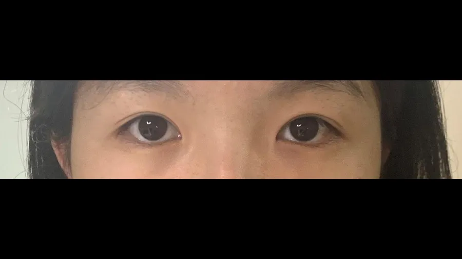 Incisional Double Eyelid Surgery, Ptosis Correction — RE&RE PLASTIC SURGERY 5