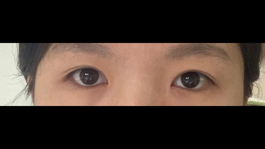 Incisional Double Eyelid Surgery, Ptosis Correction — RE&RE PLASTIC SURGERY 6