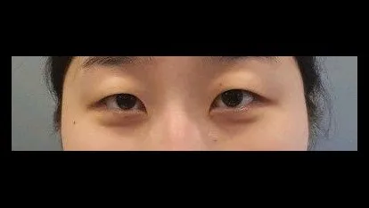 Partial Incision Double Eyelid Surgery, Ptosis Correction — RE&RE PLASTIC SURGERY 1