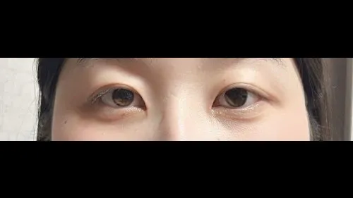 Partial Incision Double Eyelid Surgery, Ptosis Correction — RE&RE PLASTIC SURGERY 2