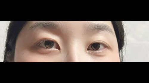 Partial Incision Double Eyelid Surgery, Ptosis Correction — RE&RE PLASTIC SURGERY 3