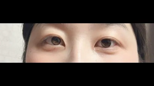 Partial Incision Double Eyelid Surgery, Ptosis Correction — RE&RE PLASTIC SURGERY 4