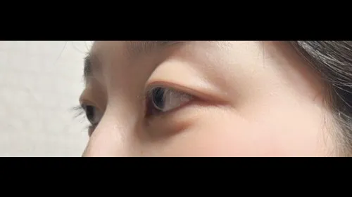 Partial Incision Double Eyelid Surgery, Ptosis Correction — RE&RE PLASTIC SURGERY 5