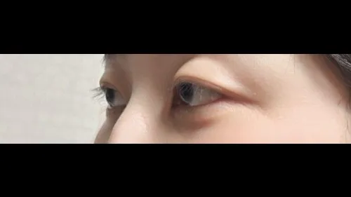 Partial Incision Double Eyelid Surgery, Ptosis Correction — RE&RE PLASTIC SURGERY 6