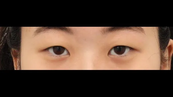 Incisional Double Eyelid Surgery, Ptosis Correction — RE&RE PLASTIC SURGERY 1