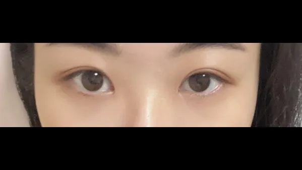 Incisional Double Eyelid Surgery, Ptosis Correction — RE&RE PLASTIC SURGERY 2