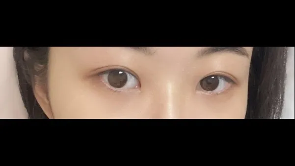 Incisional Double Eyelid Surgery, Ptosis Correction — RE&RE PLASTIC SURGERY 3