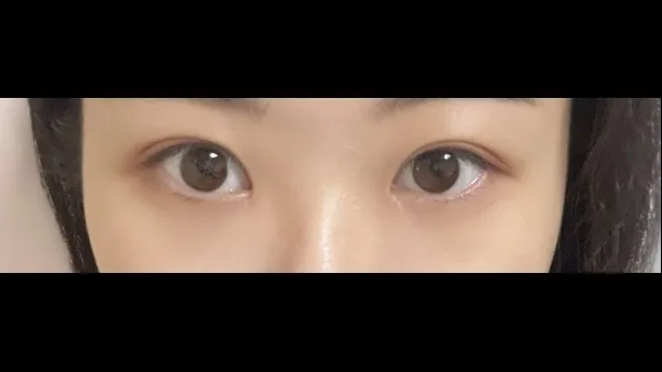 Incisional Double Eyelid Surgery, Ptosis Correction — RE&RE PLASTIC SURGERY 5