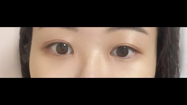 Incisional Double Eyelid Surgery, Ptosis Correction — RE&RE PLASTIC SURGERY 6