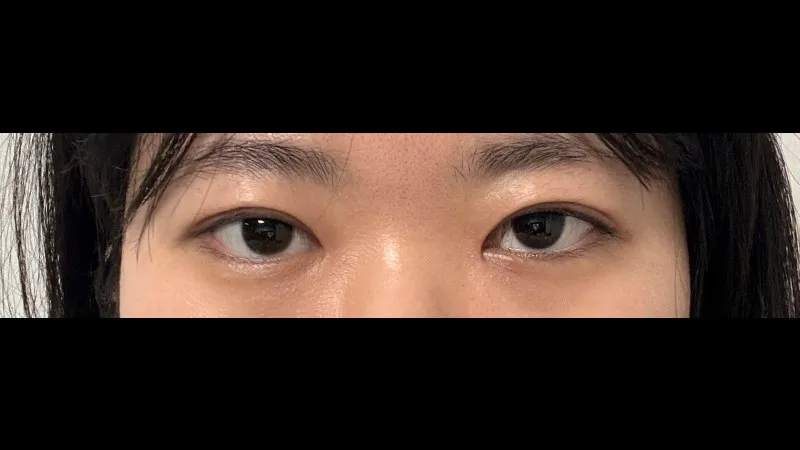 Incisional Double Eyelid Surgery, Ptosis Correction — RE&RE PLASTIC SURGERY 2