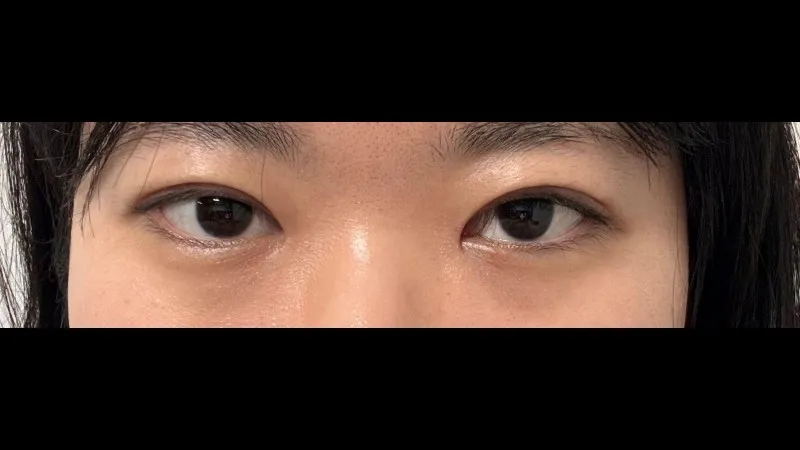 Incisional Double Eyelid Surgery, Ptosis Correction — RE&RE PLASTIC SURGERY 5