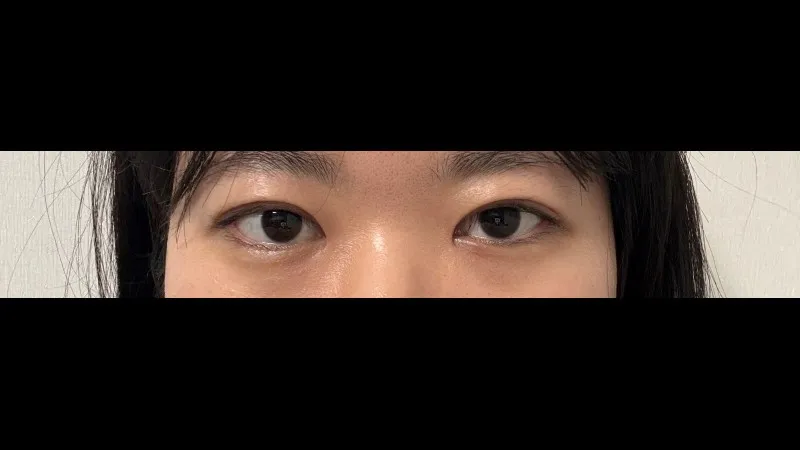 Incisional Double Eyelid Surgery, Ptosis Correction — RE&RE PLASTIC SURGERY 6
