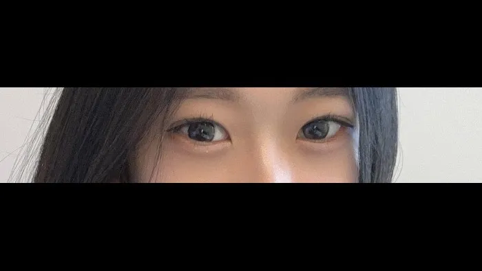 Natural Adhesion Double Eyelid Surgery, Ptosis Correction — RE&RE PLASTIC SURGERY 2