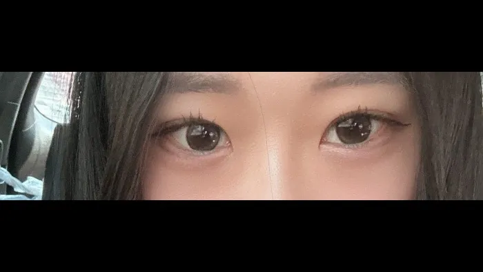Natural Adhesion Double Eyelid Surgery, Ptosis Correction — RE&RE PLASTIC SURGERY 3