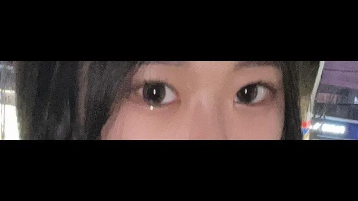 Natural Adhesion Double Eyelid Surgery, Ptosis Correction — RE&RE PLASTIC SURGERY 4