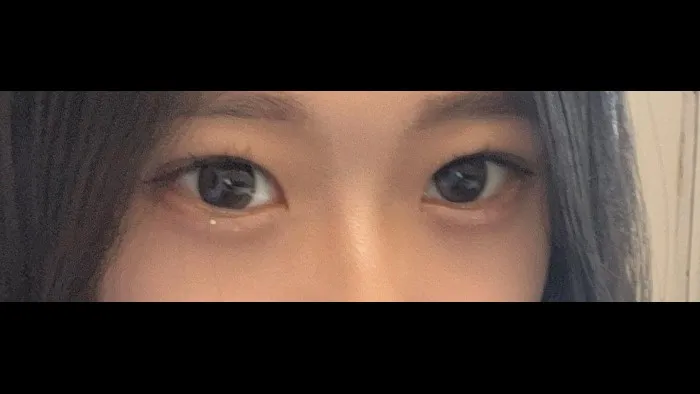 Natural Adhesion Double Eyelid Surgery, Ptosis Correction — RE&RE PLASTIC SURGERY 5