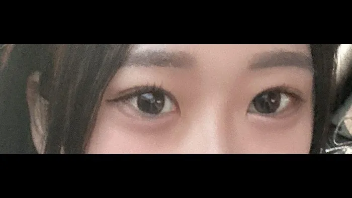 Natural Adhesion Double Eyelid Surgery, Ptosis Correction — RE&RE PLASTIC SURGERY 6