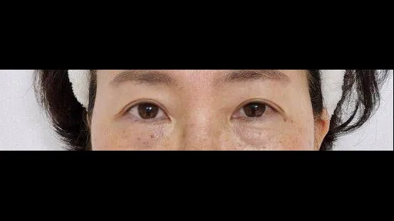Sub-brow Lift — RE&RE PLASTIC SURGERY 2