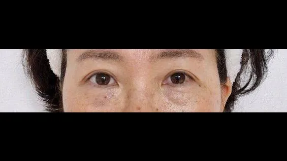 Sub-brow Lift — RE&RE PLASTIC SURGERY 3