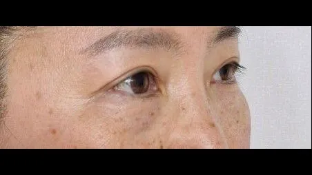 Sub-brow Lift — RE&RE PLASTIC SURGERY 4