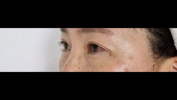 Sub-brow Lift — RE&RE PLASTIC SURGERY 5