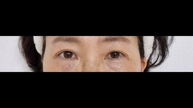 Sub-brow Lift — RE&RE PLASTIC SURGERY 6