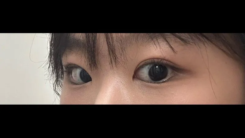 Incisional Double Eyelid Surgery — RE&RE PLASTIC SURGERY 2