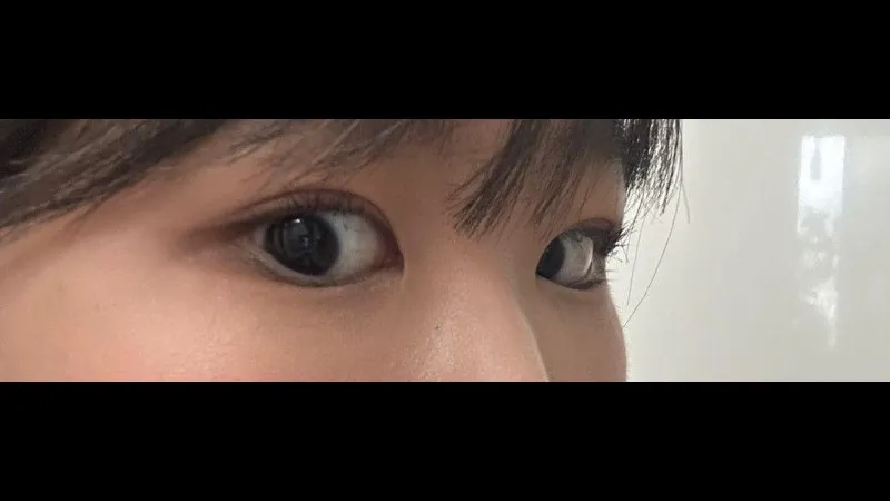 Incisional Double Eyelid Surgery — RE&RE PLASTIC SURGERY 3