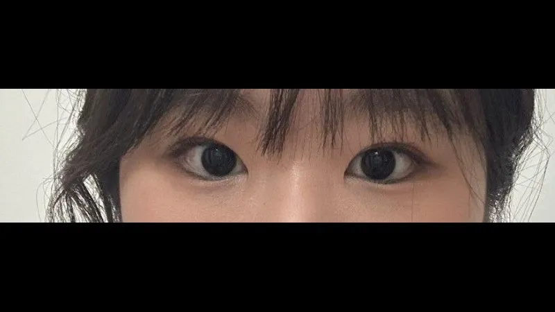 Incisional Double Eyelid Surgery — RE&RE PLASTIC SURGERY 4