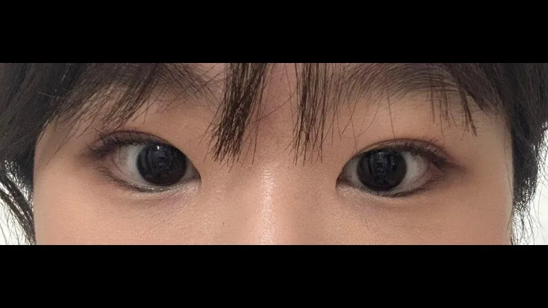 Incisional Double Eyelid Surgery — RE&RE PLASTIC SURGERY 5