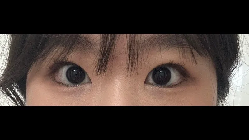 Incisional Double Eyelid Surgery — RE&RE PLASTIC SURGERY 6
