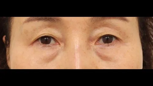 Sub-brow Lift, Lower Blepharoplasty (Aging Eye Rejuvenation) — RE&RE PLASTIC SURGERY 1