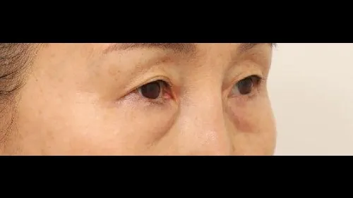 Sub-brow Lift, Lower Blepharoplasty (Aging Eye Rejuvenation) — RE&RE PLASTIC SURGERY 2